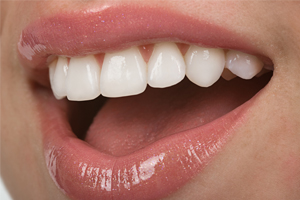 Beautiful Porcelain Veneers