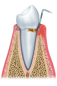 Initial Periodontal Disease