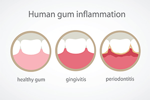 Gum Inflammation