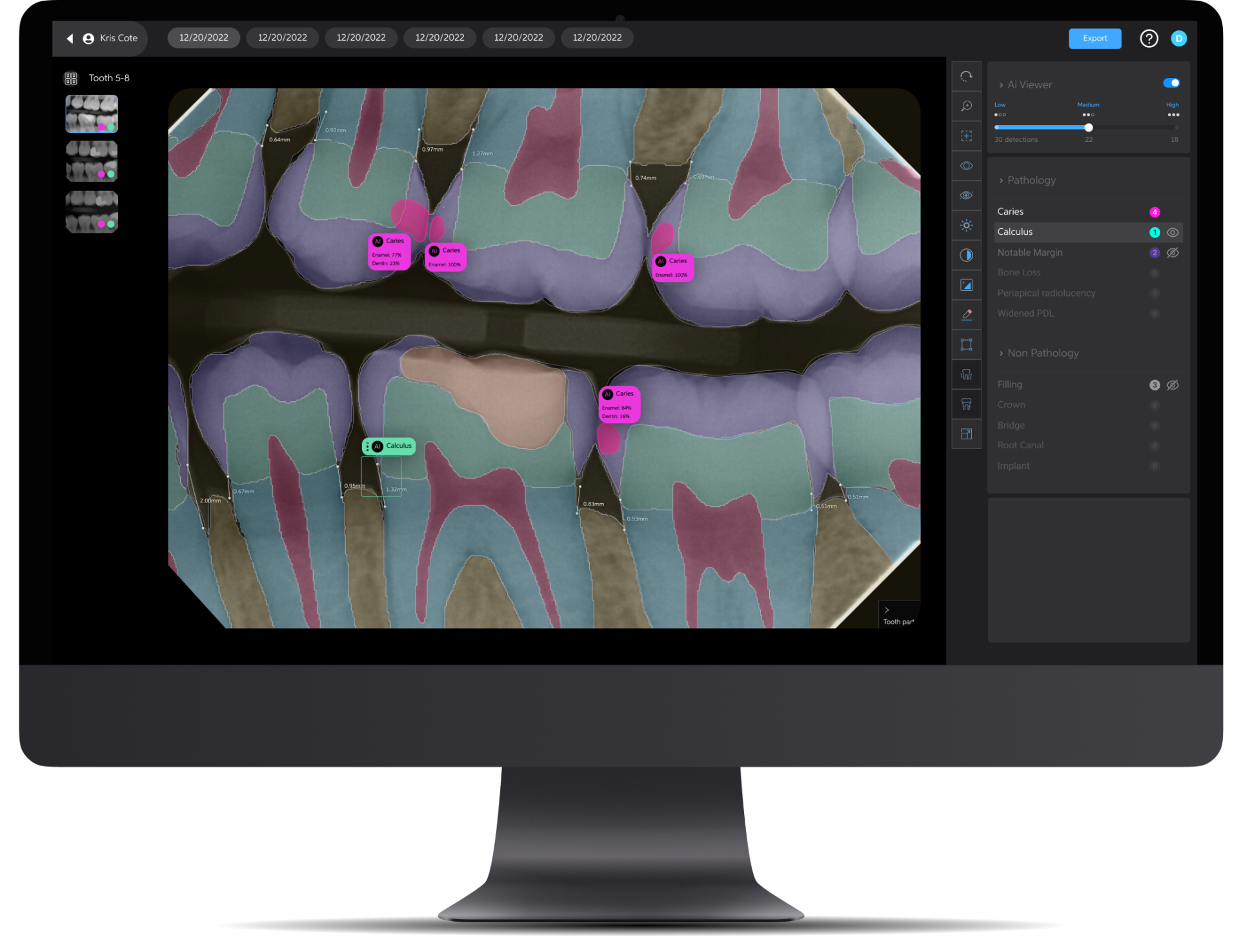 How Ai Technology Like Overjet Is Transforming Dentistry — And Why Z Family Dental Is Different 1 AI X-Ray Analysis Fairfax, VA | Improved Detection | Dentcare Now